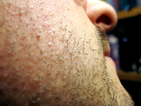 How To Prevent Ingrown Hairs and Razor Bumps With ...