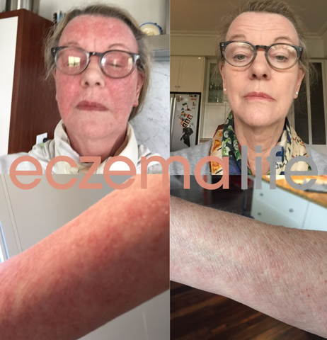 Eczema diet and Skin Friend before and after images 