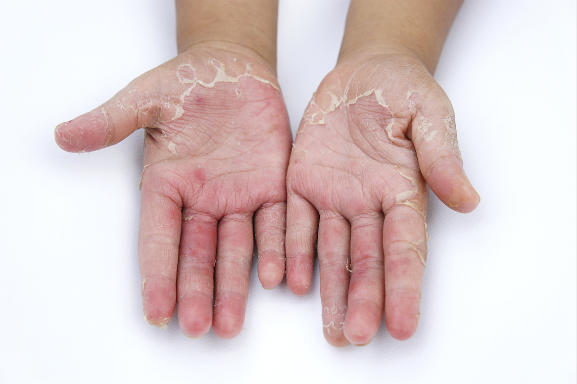 Contact Dermatitis Rashes On Caucasian Skin Royalty-Free Stock Image ...