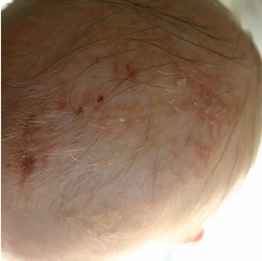 cradle cap at home treatment