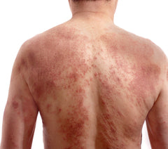 eczema atopic dermatitis