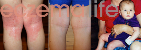 Ayva with eczema before and after