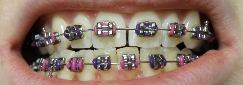 Metal dental braces