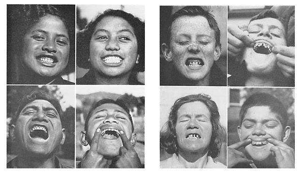 On the left, New Zealand primitive natives, the Maori, that have had the reputation of having the finest teeth and finest bodies of any race in the world. On the right, modernized whites of New Zealand, claimed to have the poorest teeth in the world.