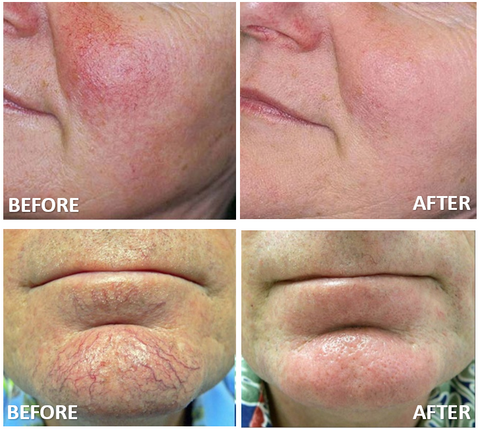 Icon Palomar Pigmentation Vascular Before and After Photos