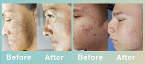 SQT BIO MIcroneedling Acne Scarring Hyperpigmentation Brightening Treatment