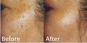 Skin Growth Removal