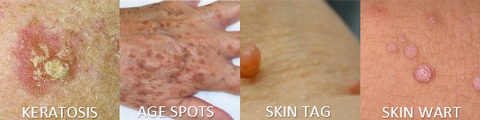 Examples of Skin Growth Removals