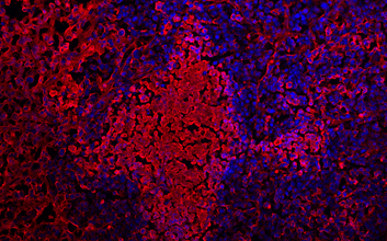 Immunofluorescent staining of sodium iodide symporter (NIS) expressing oncolytic virus infection stained with anti-NIS VJ1 antibody using Alexa 555 secondary