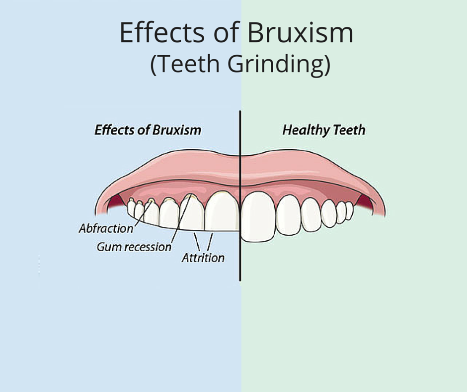 4 things you didn't know about Bruxism - AKA - Grinding, Clenching, Cl -  Impact Mouthguards