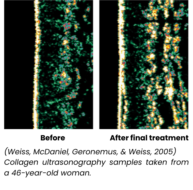 Increase in collagen after 1 month of red light therapy treatment in the face of middle aged woman