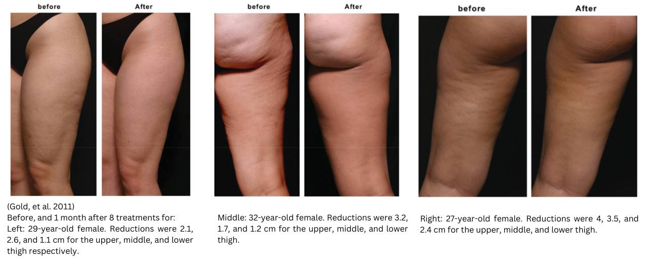 Before and after red light therapy shows a reduction in thigh circumference and a reduction in the appearance of cellulite in women