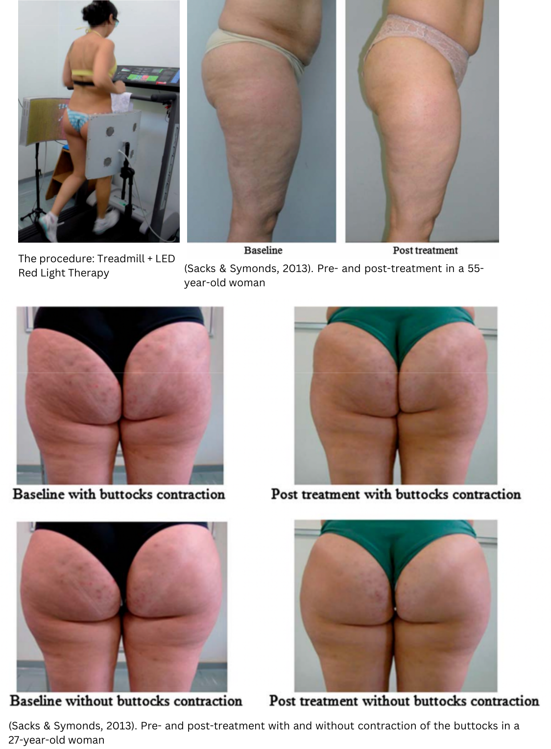 pre- and post-red light therapy treatment. Red light combined with treadmill training leads to reduction in cellulite.