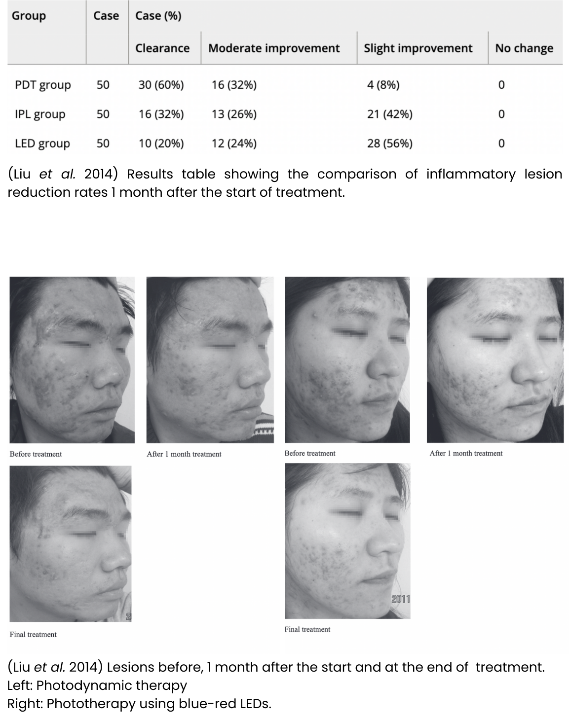 before and after red light therapy treatment. red light leads to a reduction in the appearance of acne, number of pimples, and inflammation of pimples