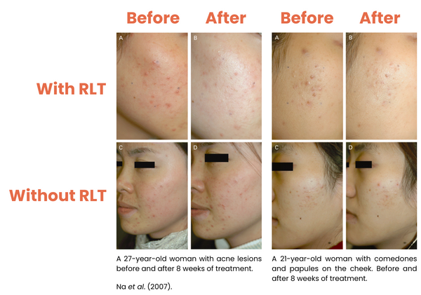 Appearance of acne, and number of pimples, before and after red light therapy treatment.