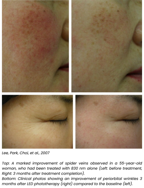 Images showing a clinical improvement of redness, spider veins, and wrinkles in two separate women after using red light and near-infrared light therapy.
