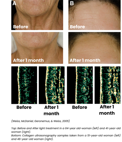 (Top) 64 and 41 year old women showing improved reduction in wrinkles after red light and near-infrared light LED treatment. (Bottom) Collagen ultrasonography samples demonstrating increase in collagen density after red light therapy in a 51 and 46 year old woman.