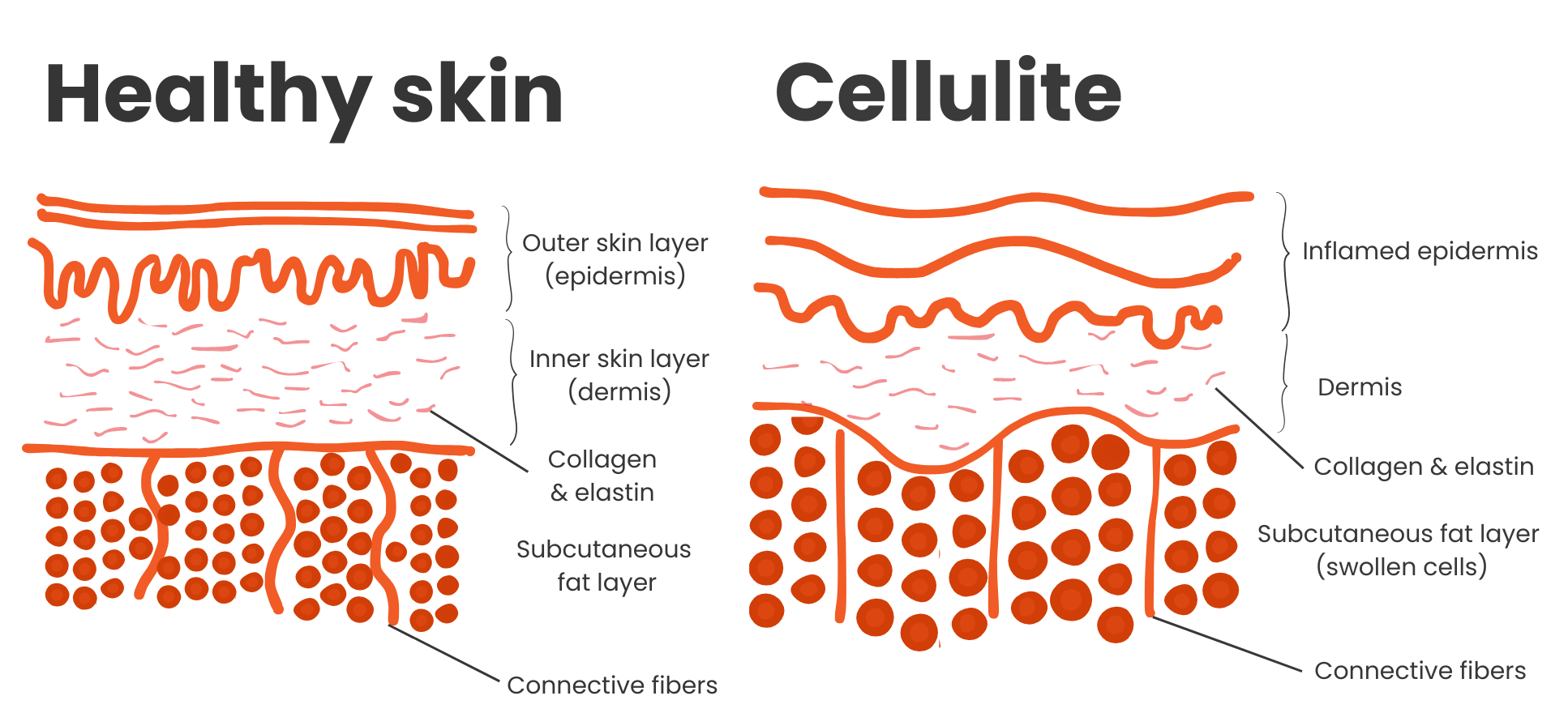 How cellulite forms versus how normal skin looks. Difference in collagen and elastin fibers, subcutaneous fat