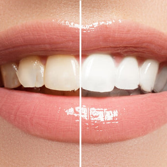 googong-dental-teeth-whitening.jpg__PID:787e37b4-0634-4f48-84e7-e1fd0ec7453f