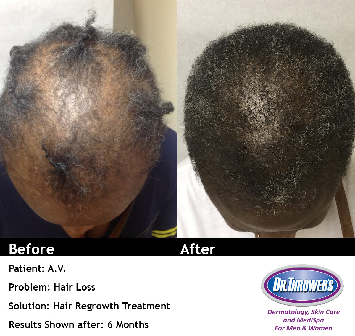 Dr. Thrower's Skin Care Thro-Grower with Minoxidil 5% Hair Regrowth Before & After