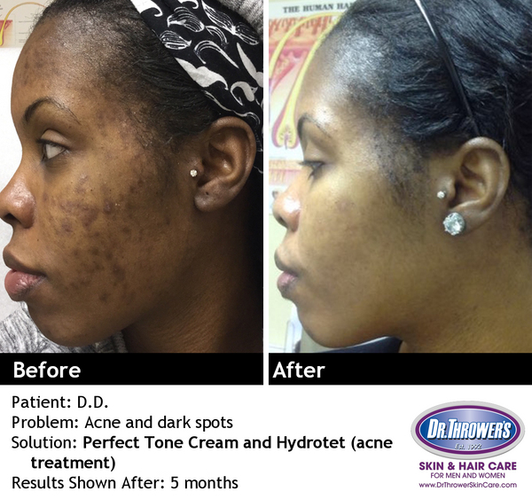 Perfect Tone Cream  Stubborn Discoloration Remover – Dr. Thrower's Skin  Care