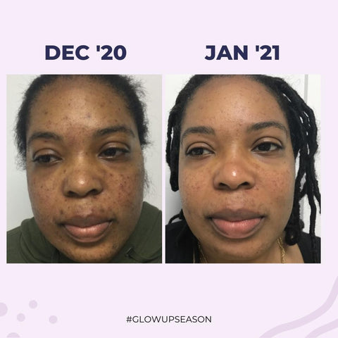 Hyperpigmentation resolved after using Dr. Thrower's Skincare