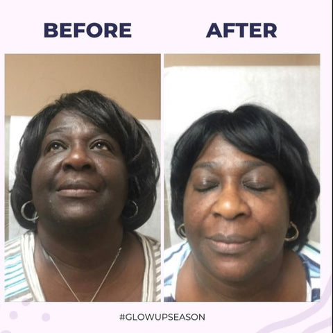 Hyperpigmentation resolved after using Dr. Thrower's Skincare