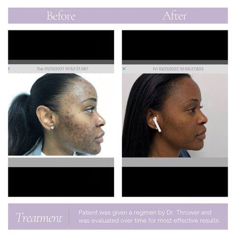 Hyperpigmentation resolved after using Dr. Thrower's Skincare