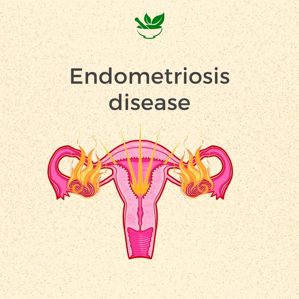 endometriosis ayurvedic mangement 30 days pack Kits of  4 QTY