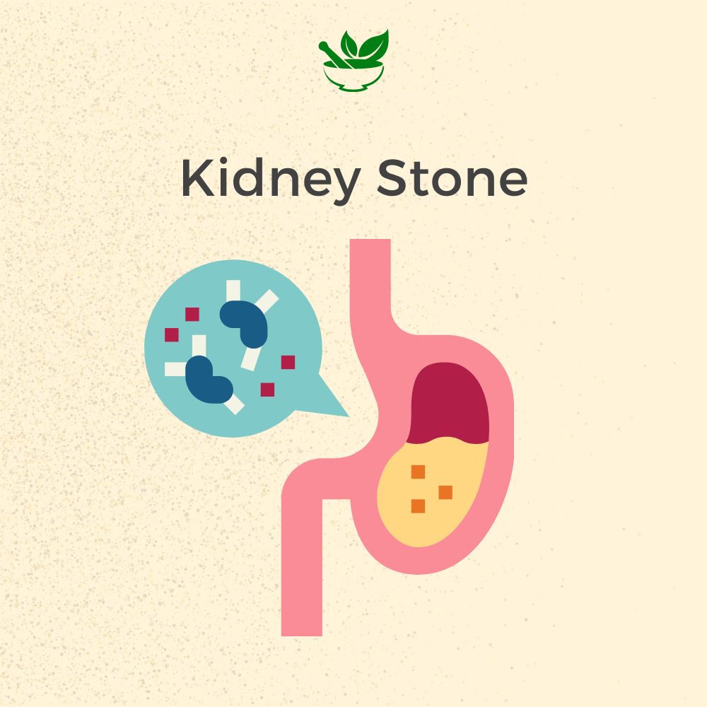 kidney stone ayurvedic mangement 30 days pack Kits of  4 QTY