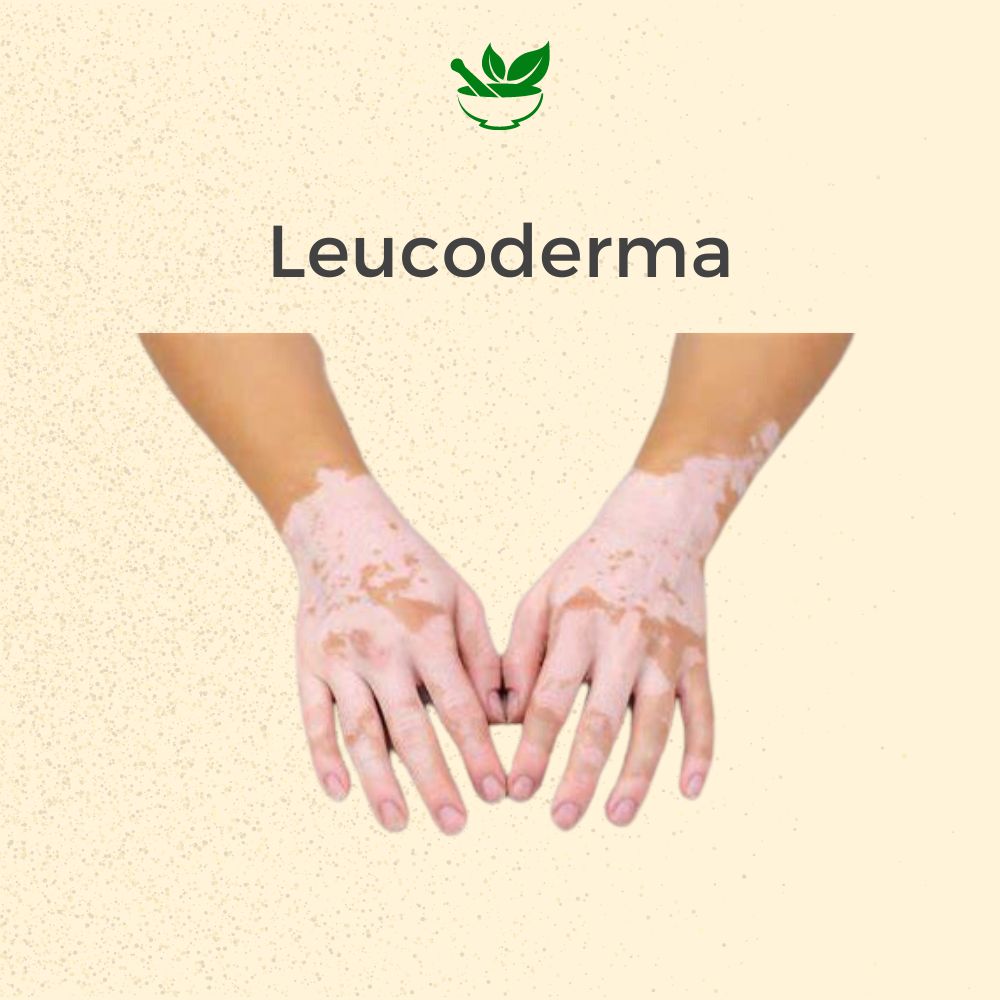 Ayurvedic Mangement Pack Leucoderma