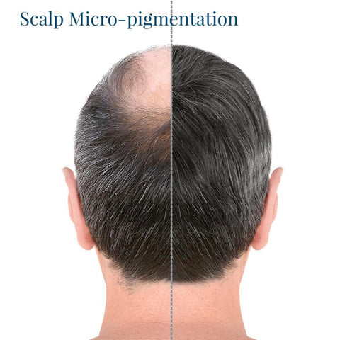 Before and after scalp micropigmentation