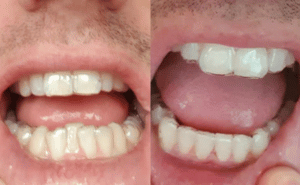 Crowded Teeth