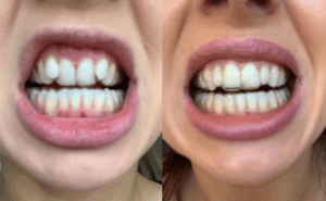 Teeth Misalignment