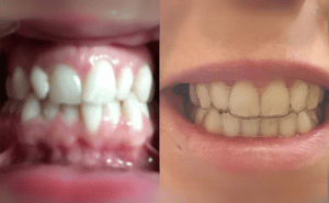 Malocclusion