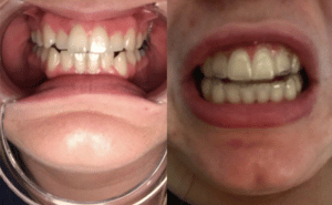 Malocclusion