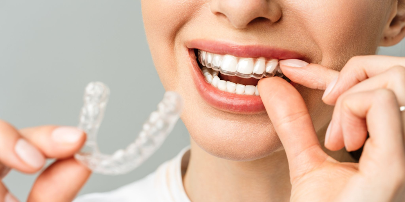 At-home teeth straightening with clear aligners