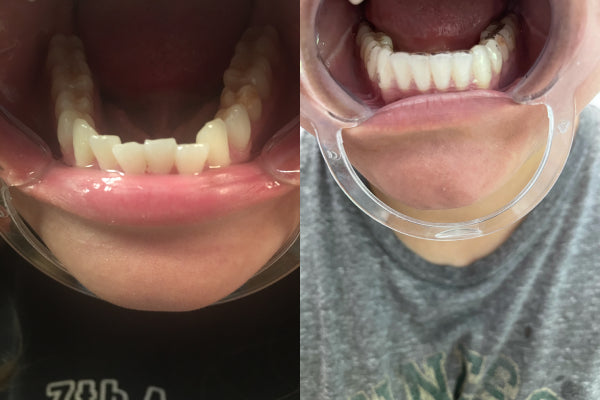 A patient with crowded teeth
