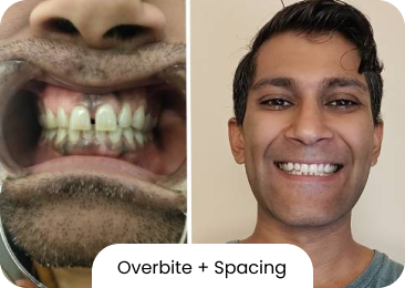 Overbite