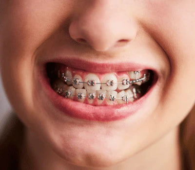 Metal Braces cost in New York