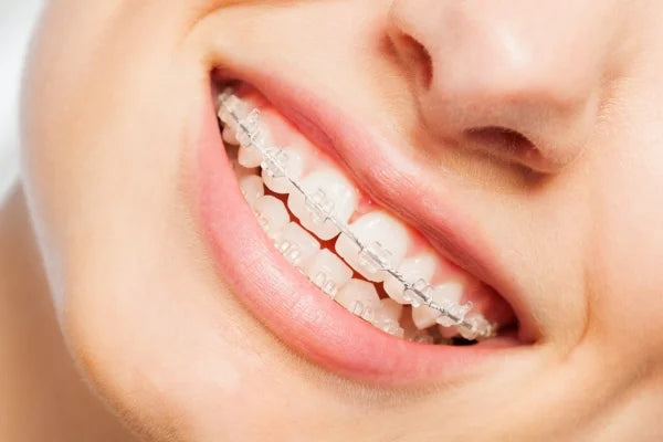 ceramic braces