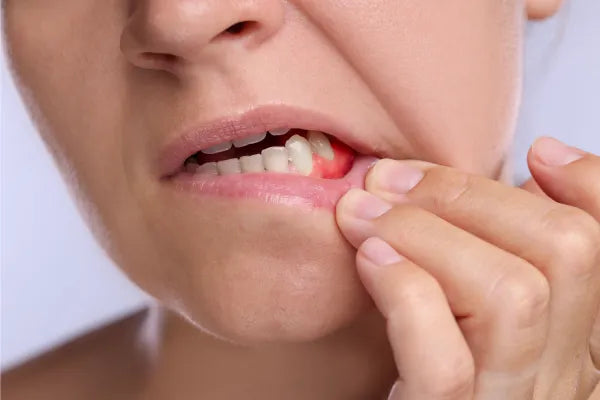 A woman showing her inflamed gums.
