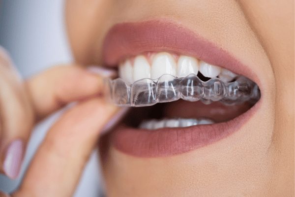 Tailor made clear aligners.