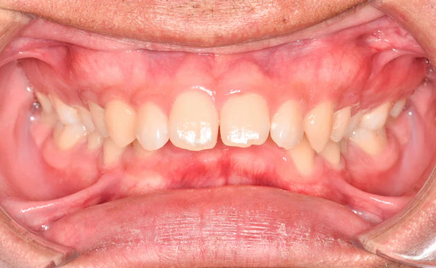 Overbite
