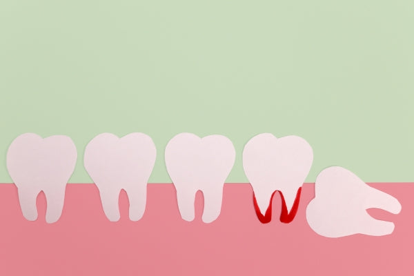 Mesial wisdom tooth 