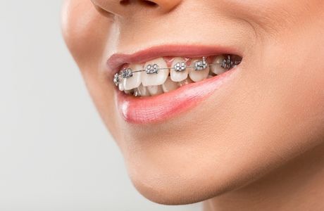 What are Metal Braces?
