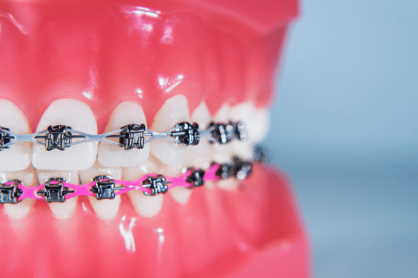 Close-up of Braces on a Model Jaw