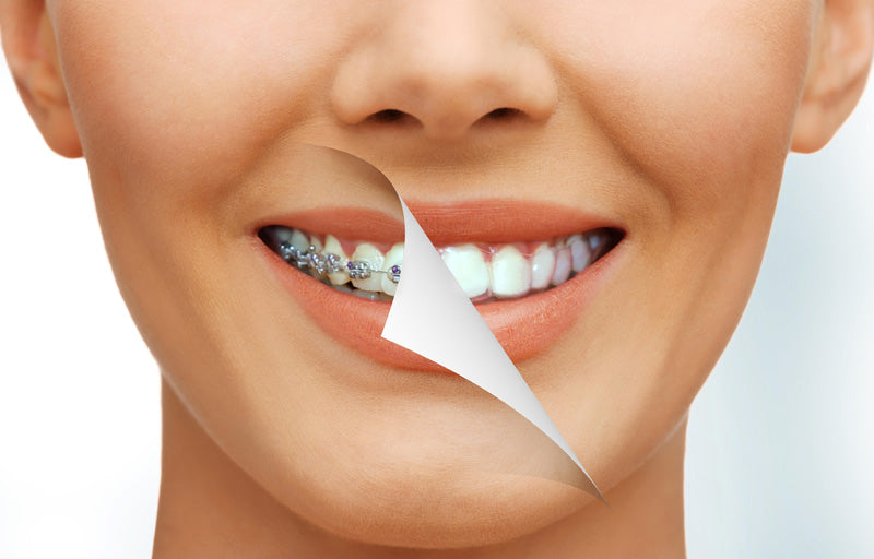 Benefits of Traditional Braces - Dentist in Springfield, MO