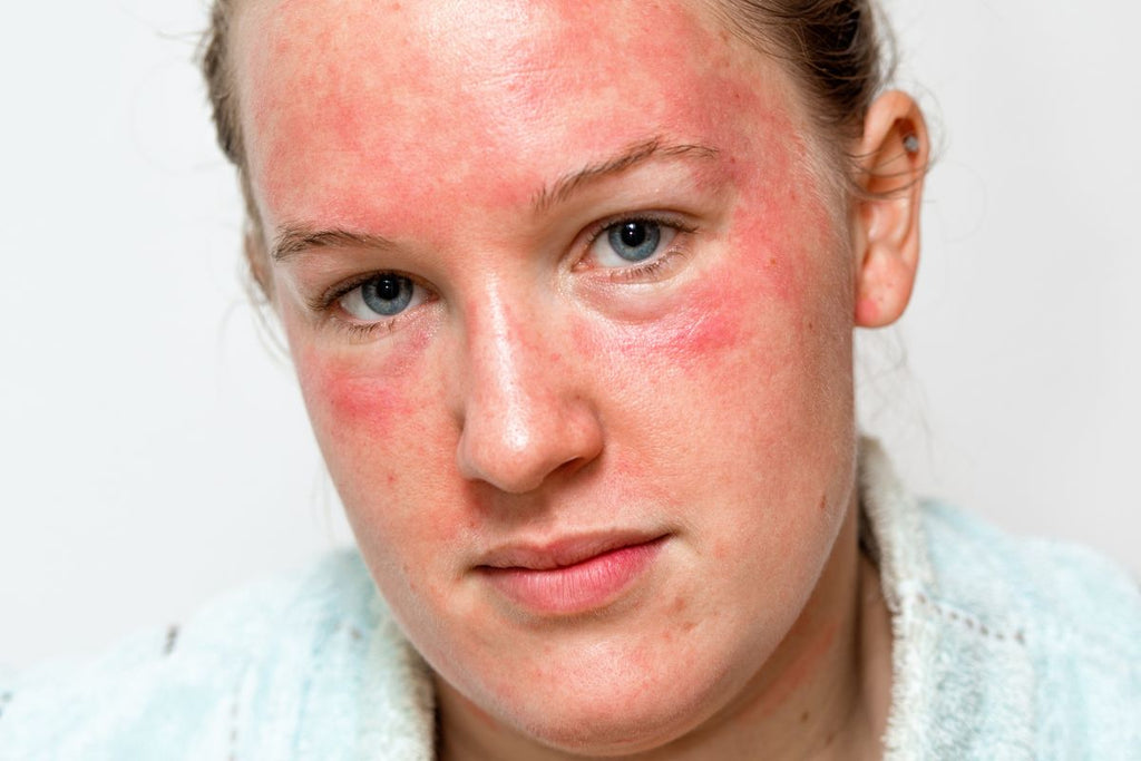 A woman with sensitive skin