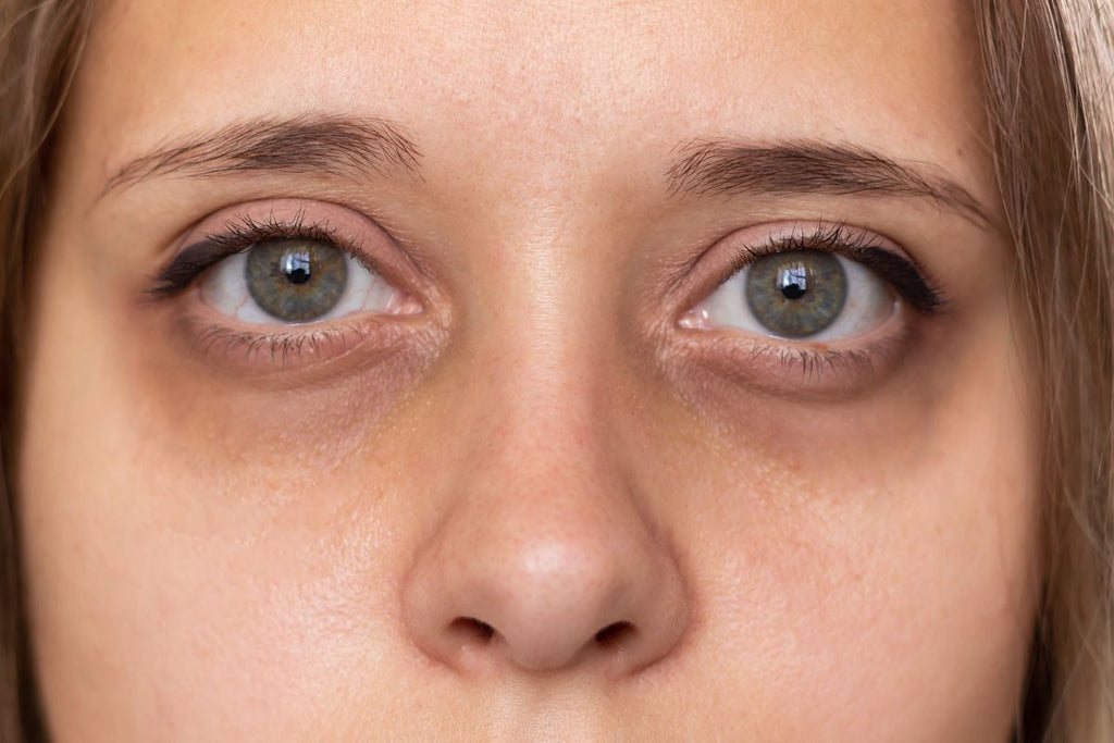 Woman with red puffy eyes due to lack of sleep